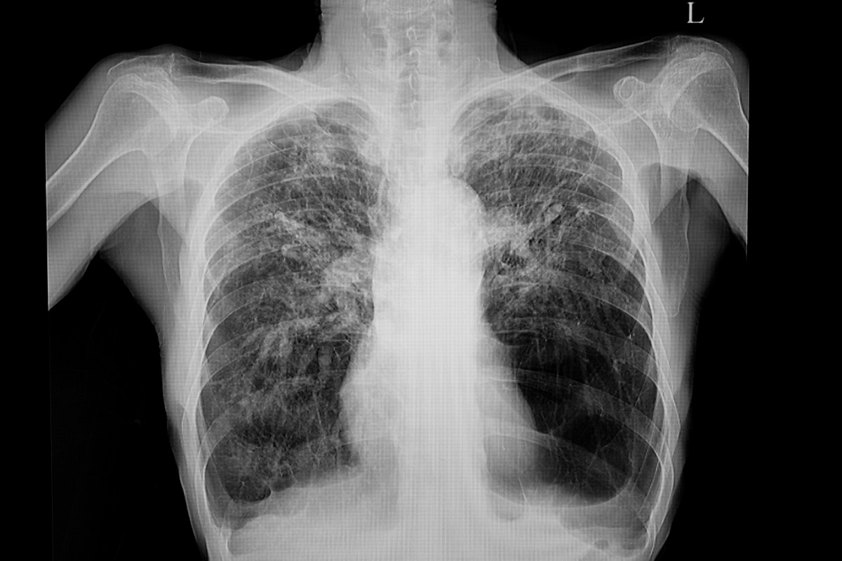 RTG snímok pľúc pri pľúcnom emfyzéme